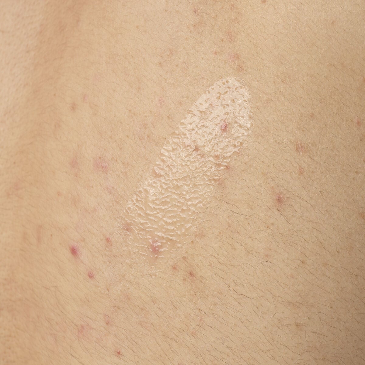 salicylic-acid-0-5-body-serum-c6 ORD-salicylic-acid-05-body-240ml-application.jpg
