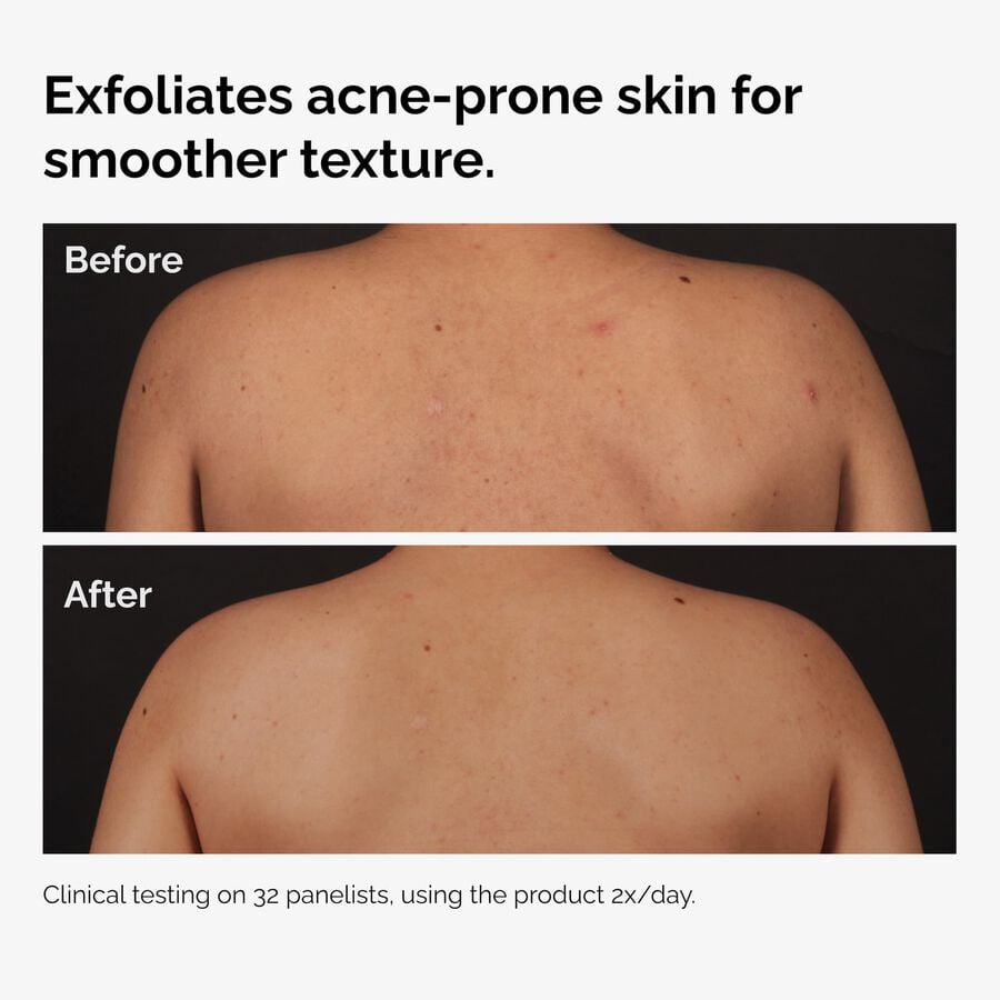 salicylic-acid-0-5-body-serum-c6 ord-salicylic-acid-body-serum-before-after-graphic-NA.jpg